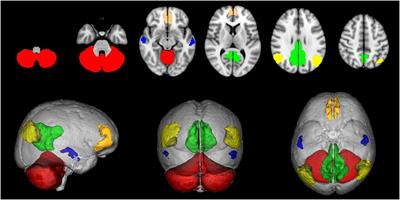 Default Mode Network Structural Integrity and Cerebellar Connectivity Predict Information Processing Speed Deficit in Multiple Sclerosis